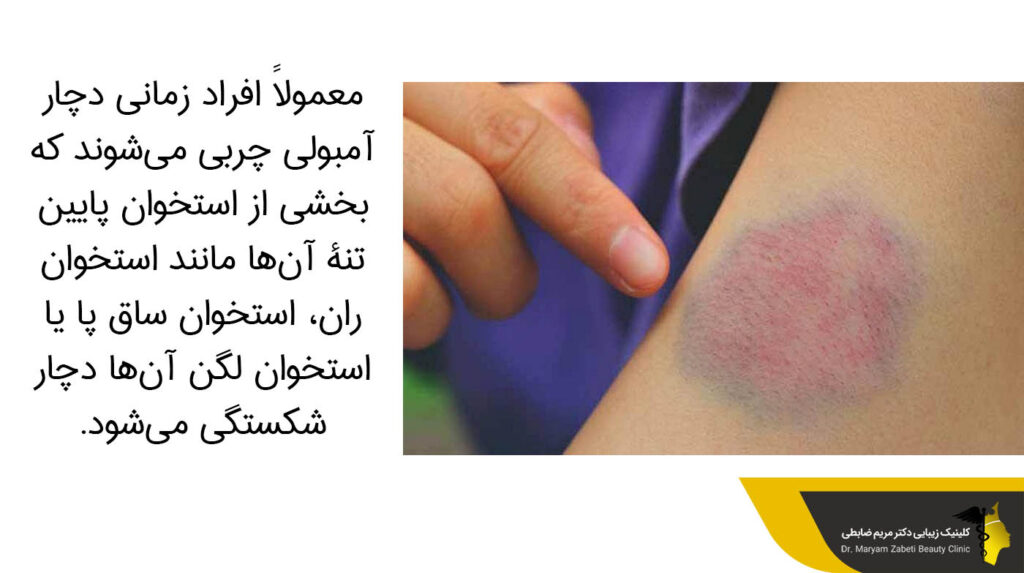 افرادی که دچار آمبولی چربی می شوند