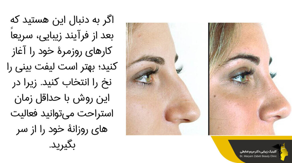 لیفت بینی و سرعت بازگشت به فعالیت های روزمرگی