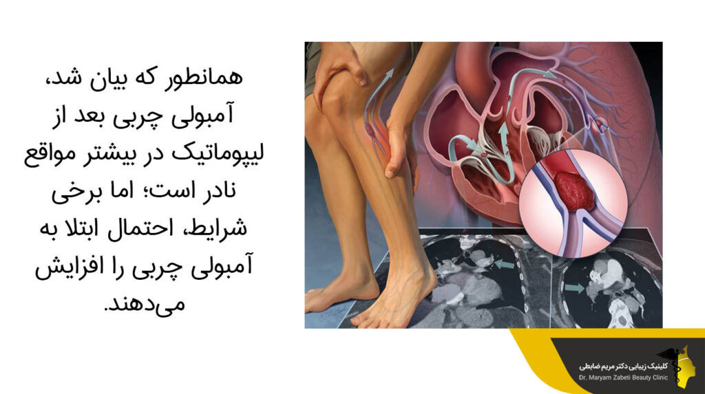 آمبولی چربی بعد از لیپوماتیک 