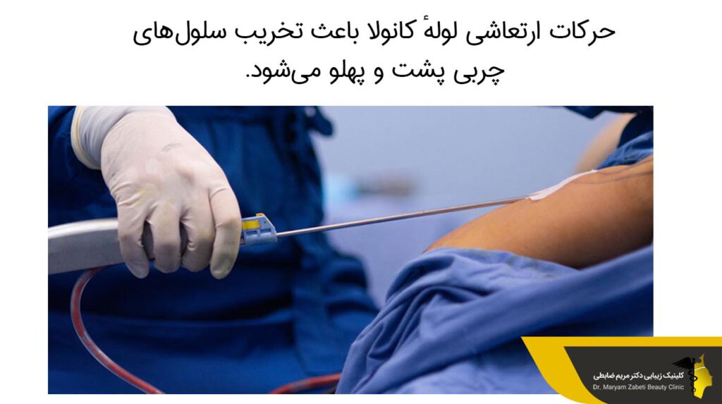 حرکات ارتعاشی لولهٔ کانولا 