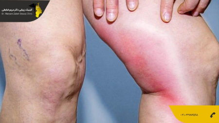 shakheslipo خطر آمبولی در لیپوماتیک