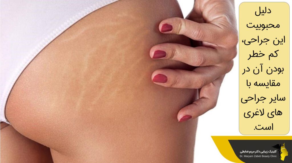 دلیل محبوبیت لیپوماتیک باسن
