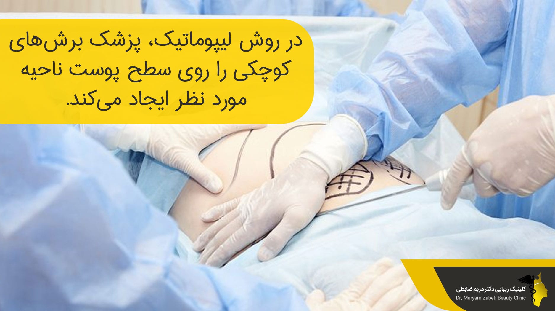 لیپوماتیک آقایان