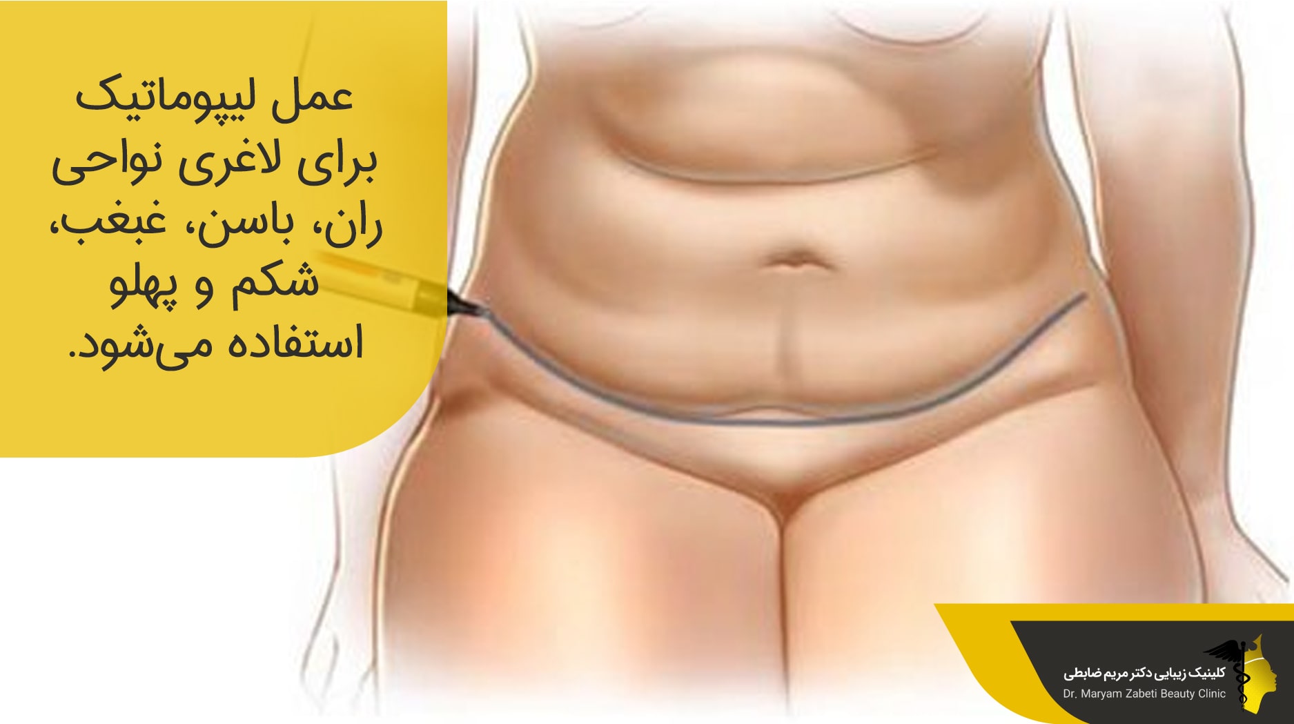 دلایل انجام لیپوماتیک 