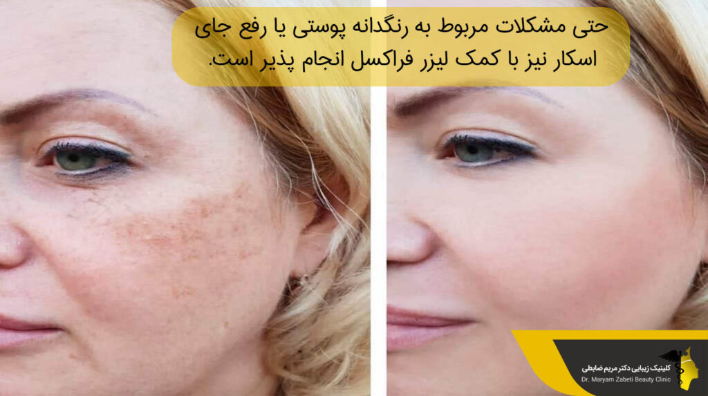 رنگدانه پوستی و لیزر فراکسل
