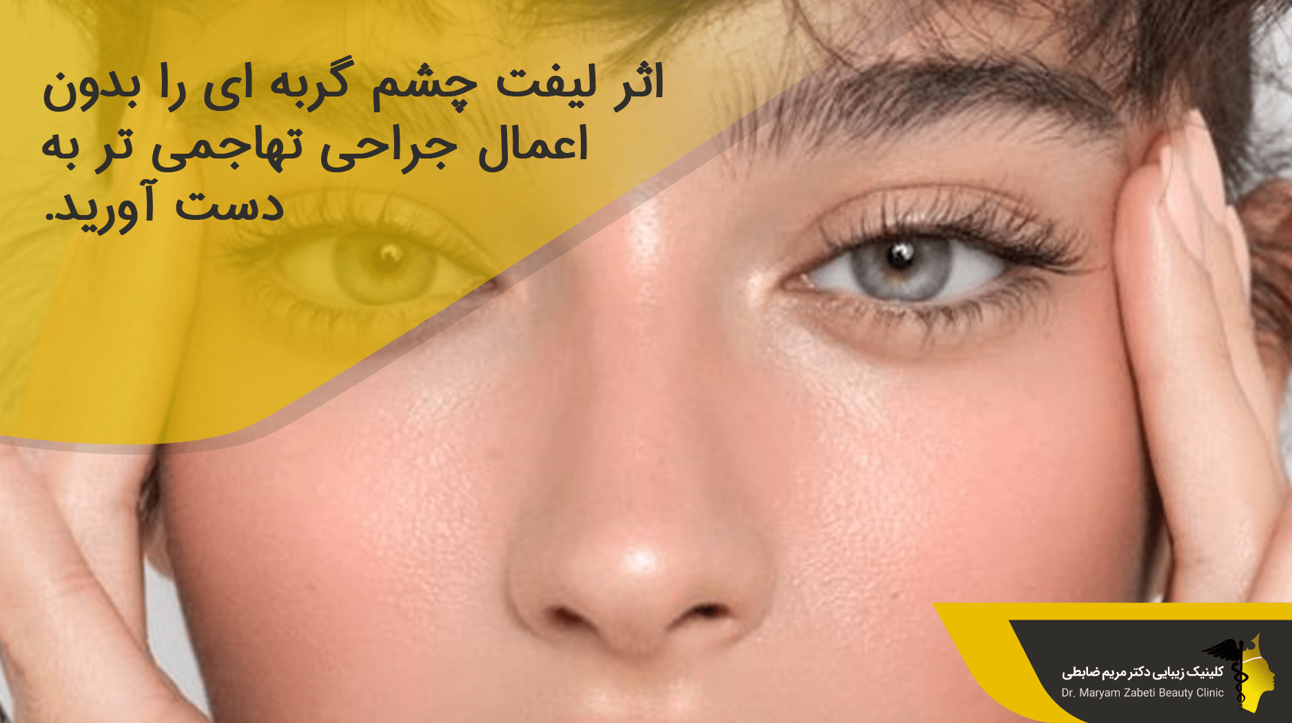 لیفت چشم گربه ای با بوتاکس