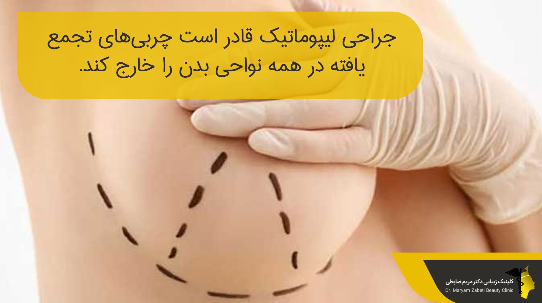 کاهش سایز بدن با لیپوماتیک
