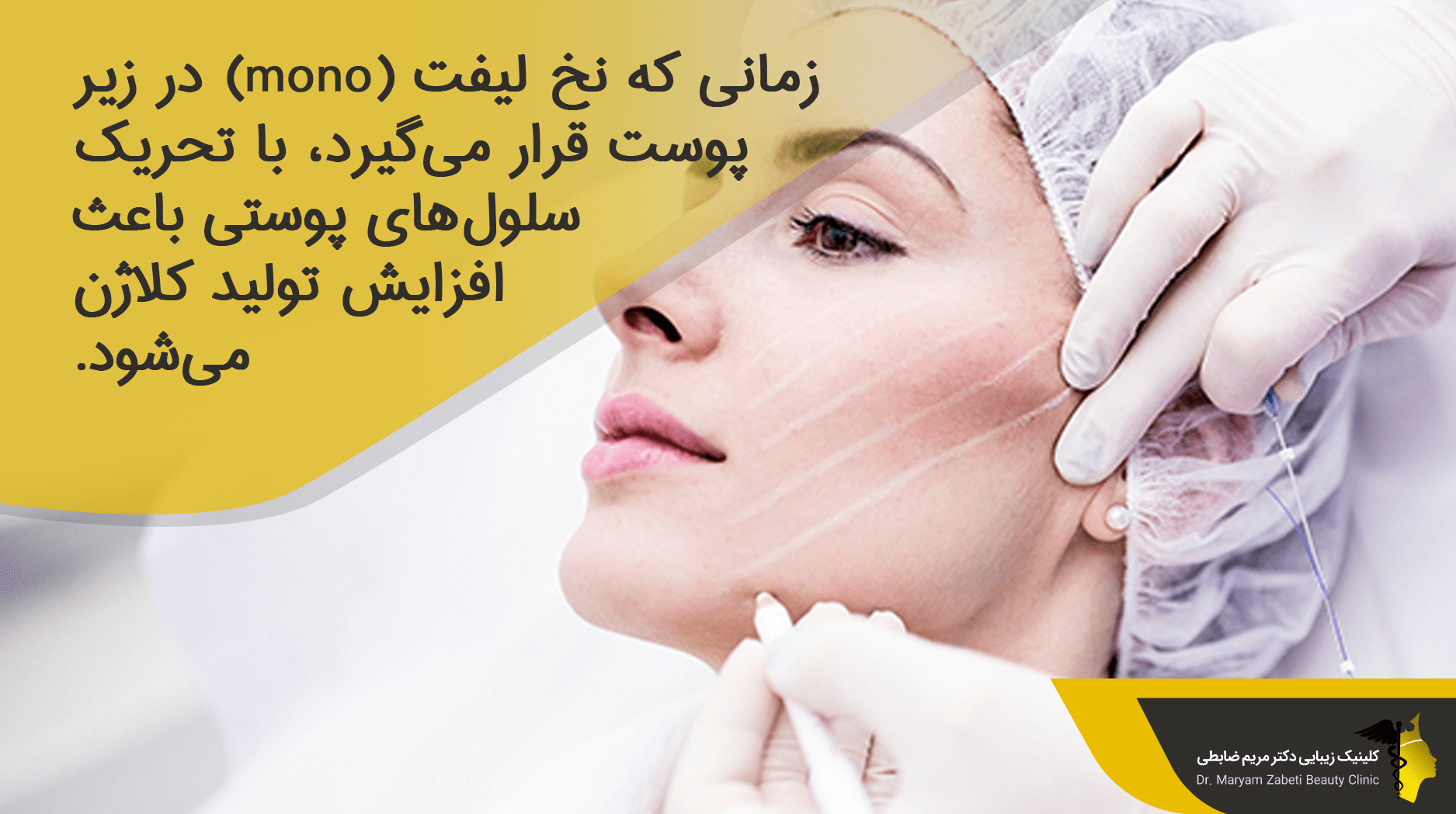 نخ لیفت (mono)