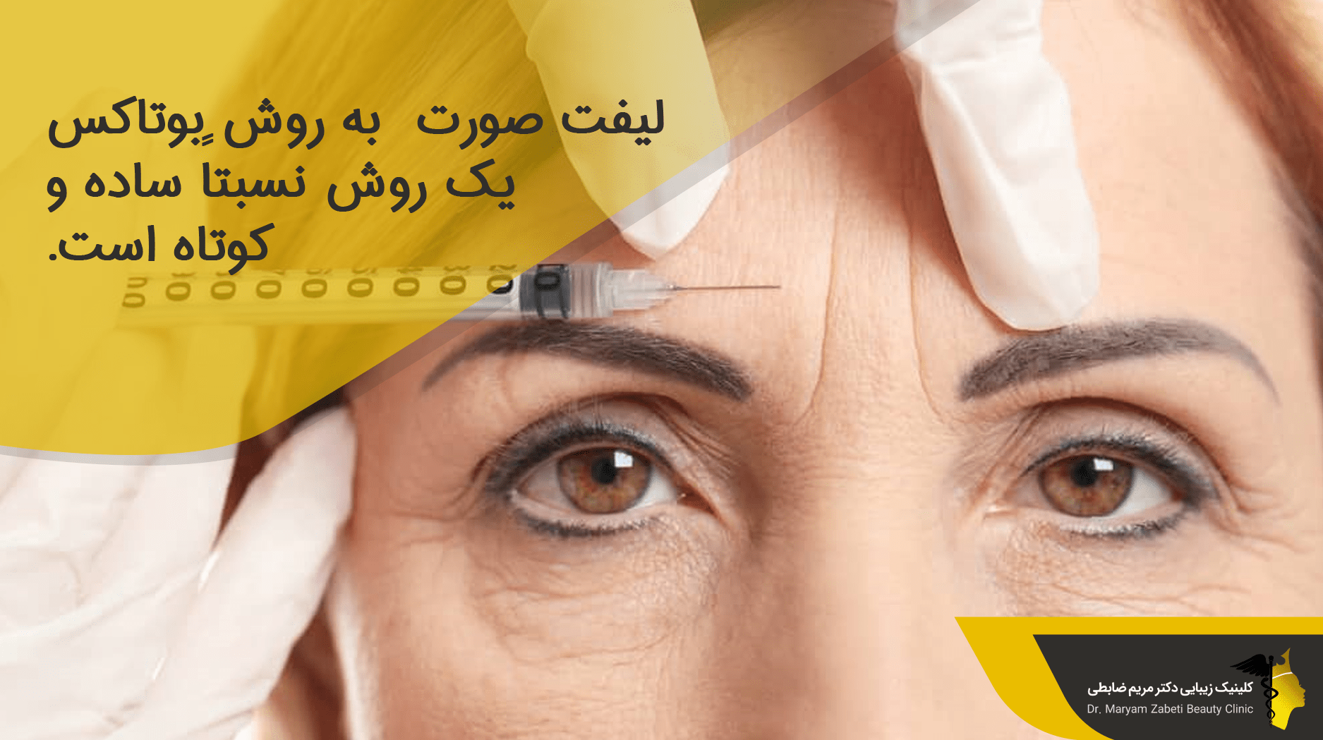 لیفت صورت  به روش بوتاکس