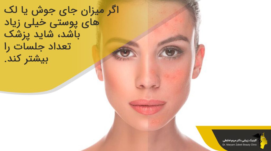 میزان جای جوش و لک‌های پوستی 
