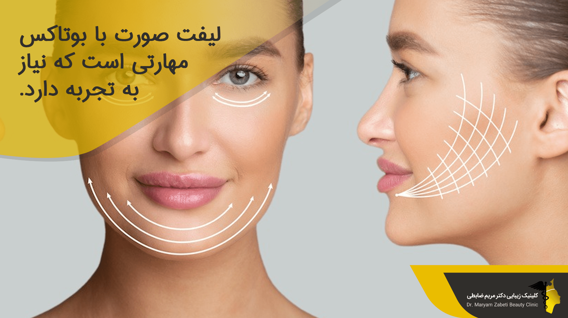 پزشک لیفت صورت با بوتاکس