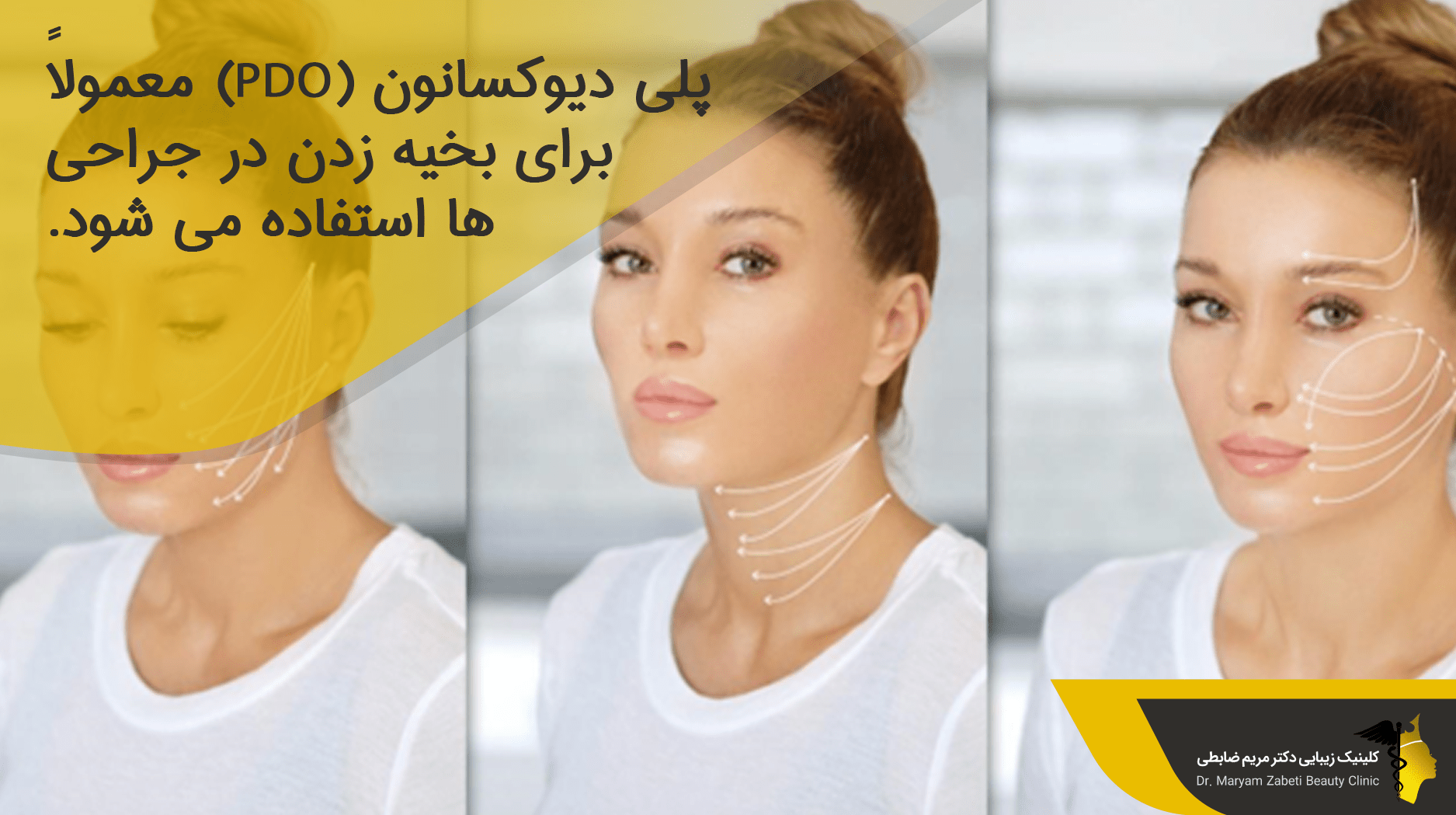 نخ های پلی دیوکسانون (PDO)