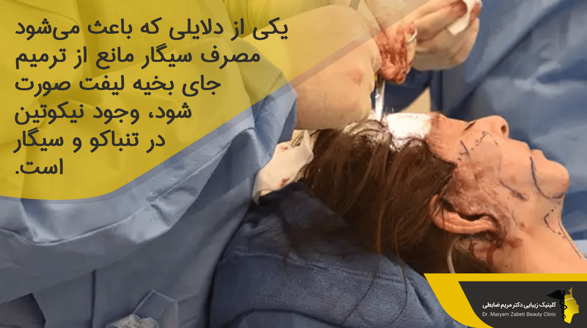 مصرف سیگار مانع از ترمیم جای بخیه لیفت صورت شود