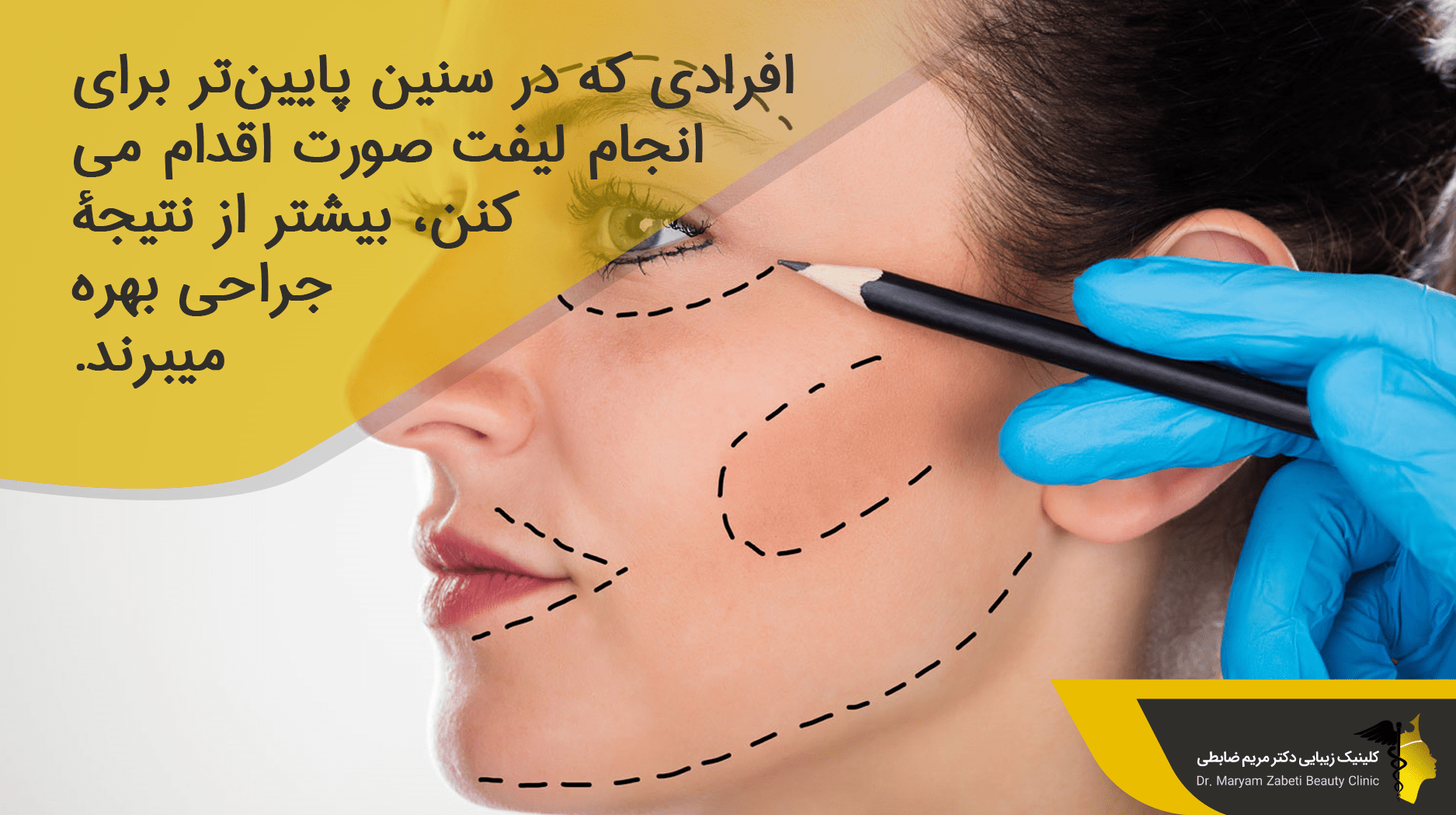 ماندگاری مینی لیفت صورت