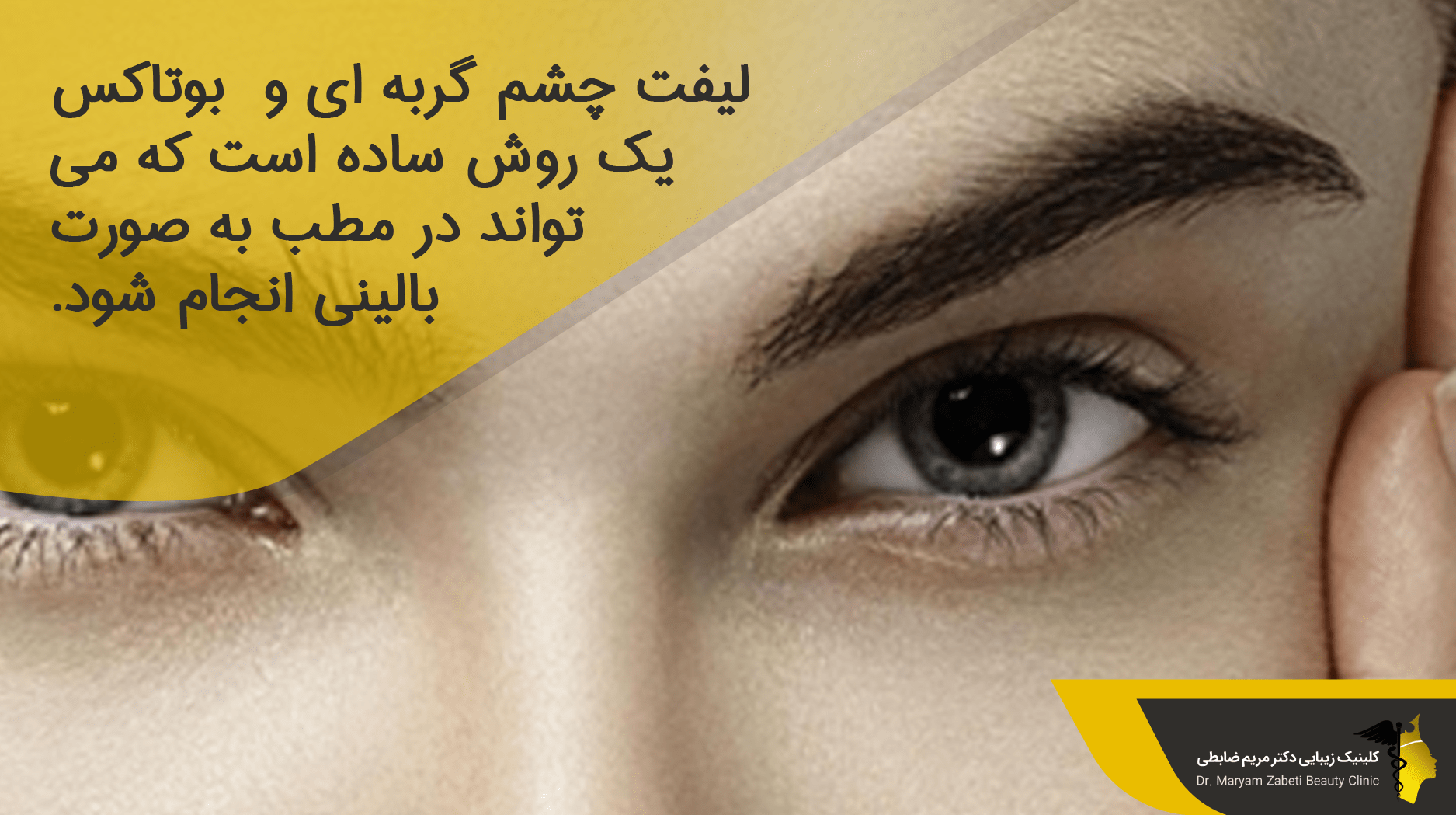 ماندگاری لیفت چشم گربه ای با بوتاکس