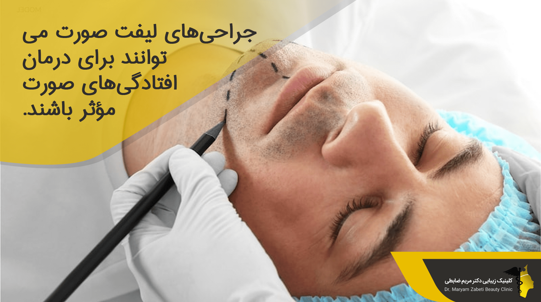 هزینه لیفت اندوسکوپی صورت 
