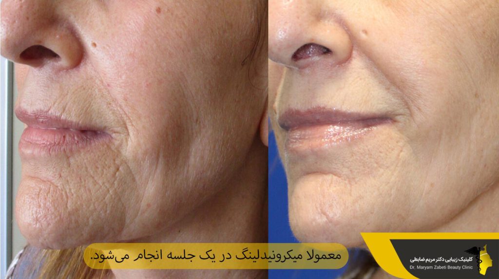 جلسات میکرونیدلینگ