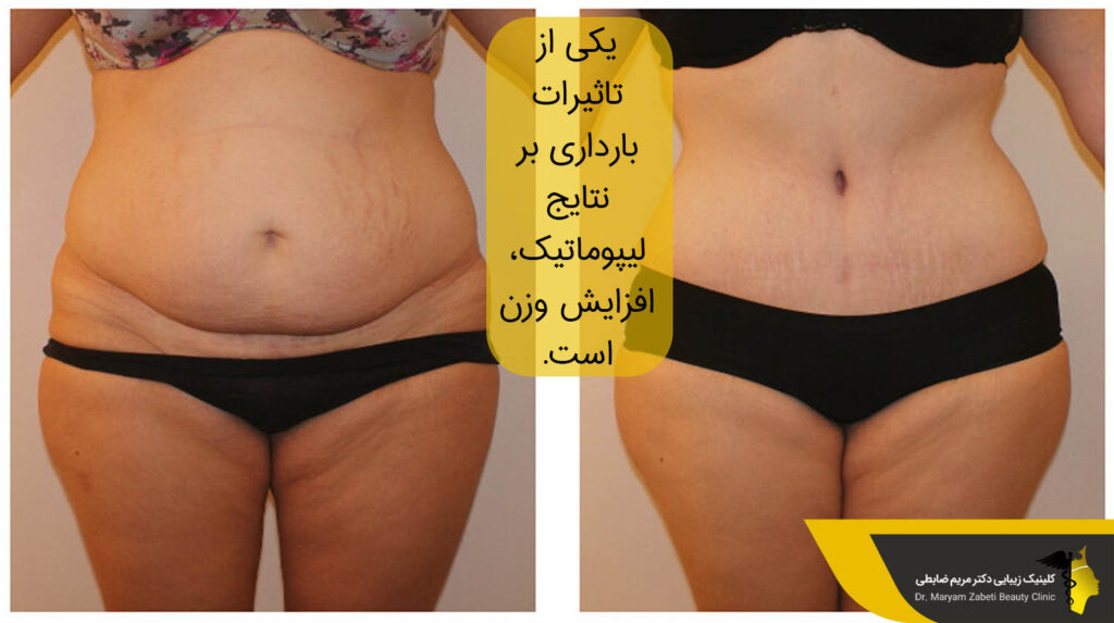 تاثیرات بارداری بر نتایج لیپوماتیک