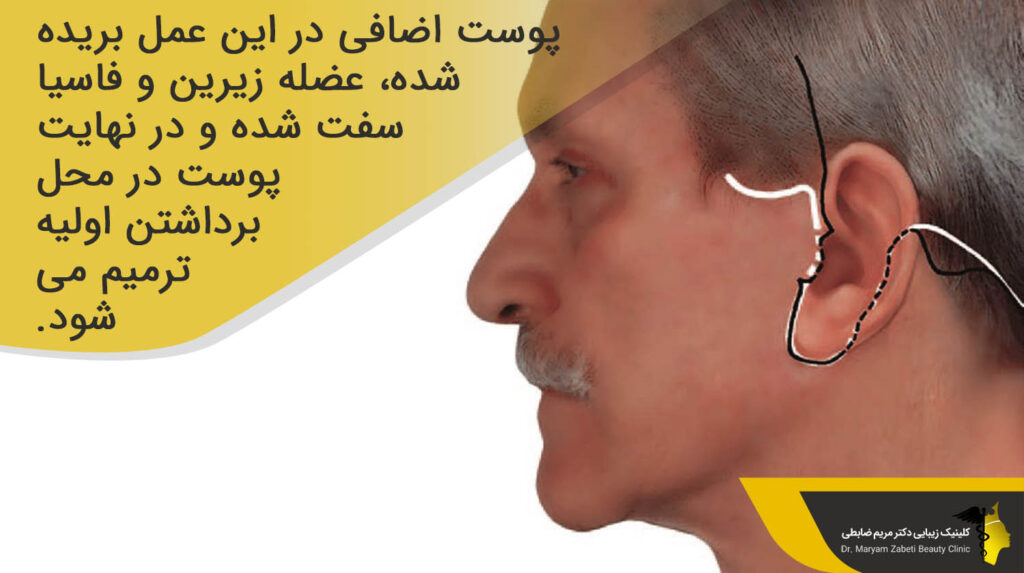 پوست اضافی در عمل لیفت صورت