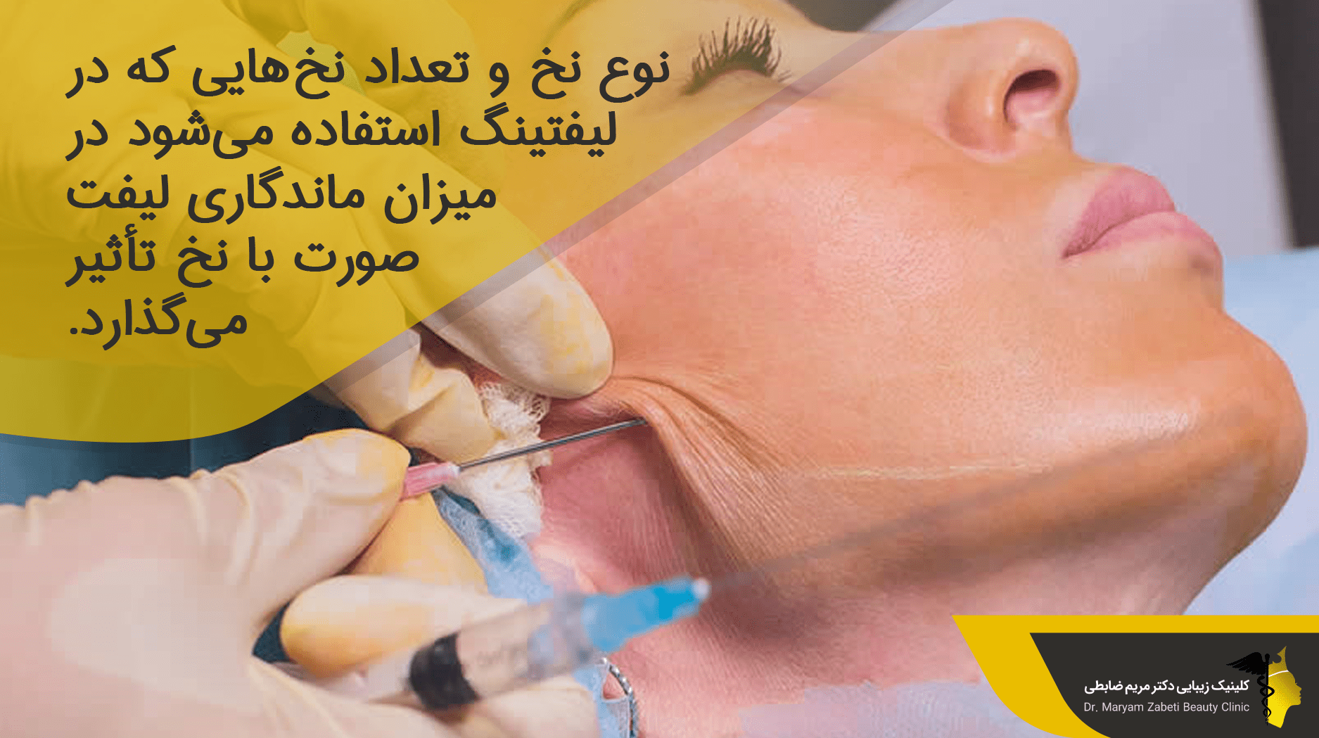 نوع و تعداد نخ استفاده شده در لیفت صورت با نخ PDO