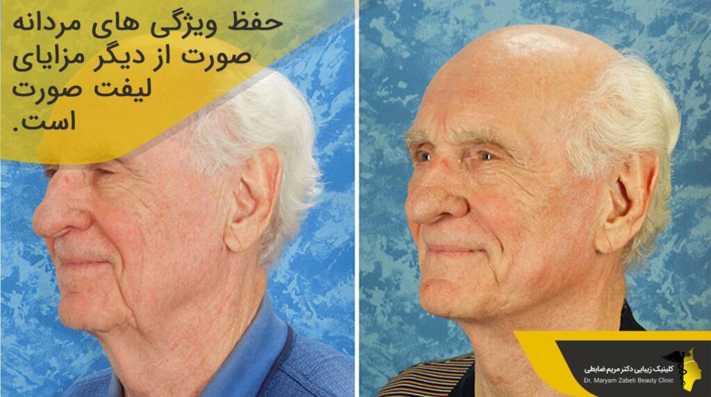 مزایای لیفت صورت آقایان