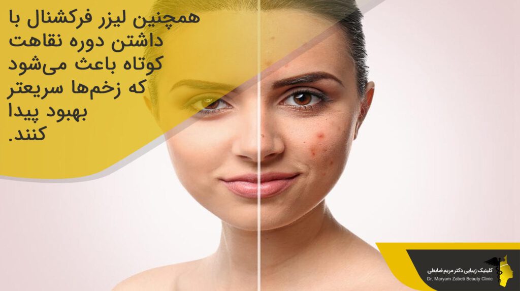 دوره نقاهت لیزر فرکشنال