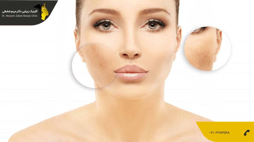 تیره شدن پوست بعد از لیزر فرکشنال