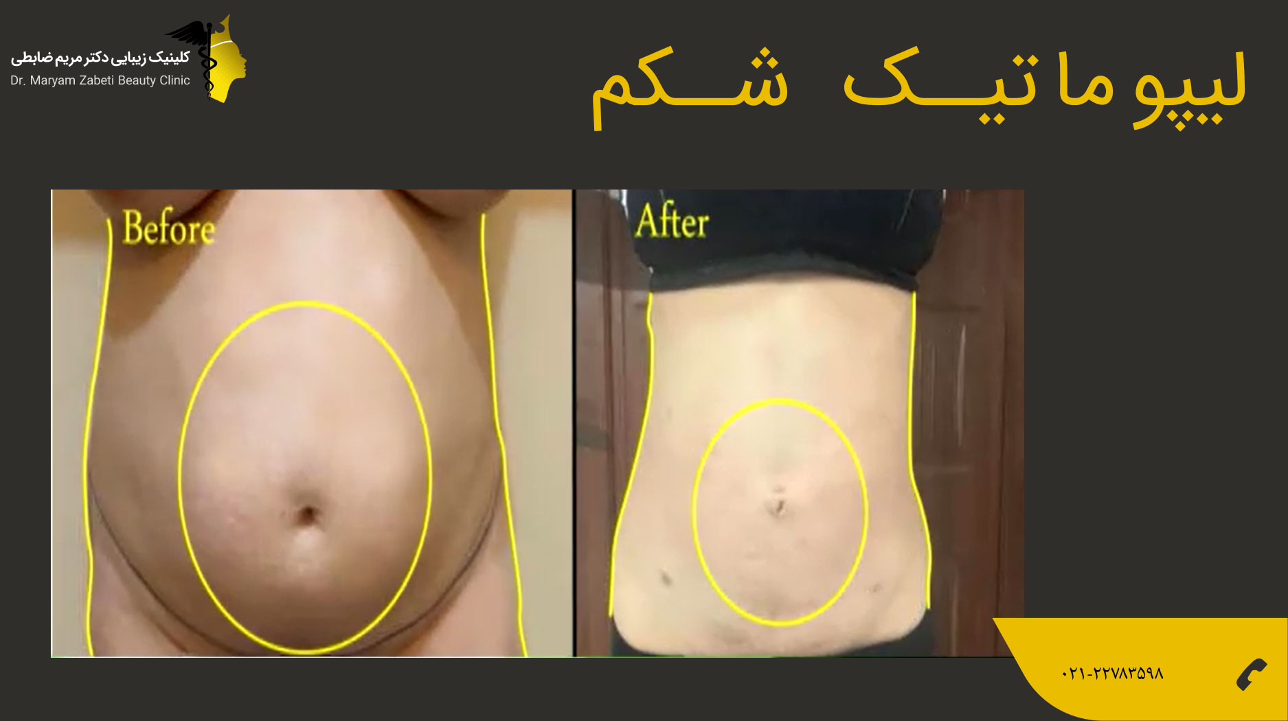 لیپوماتیک شکم