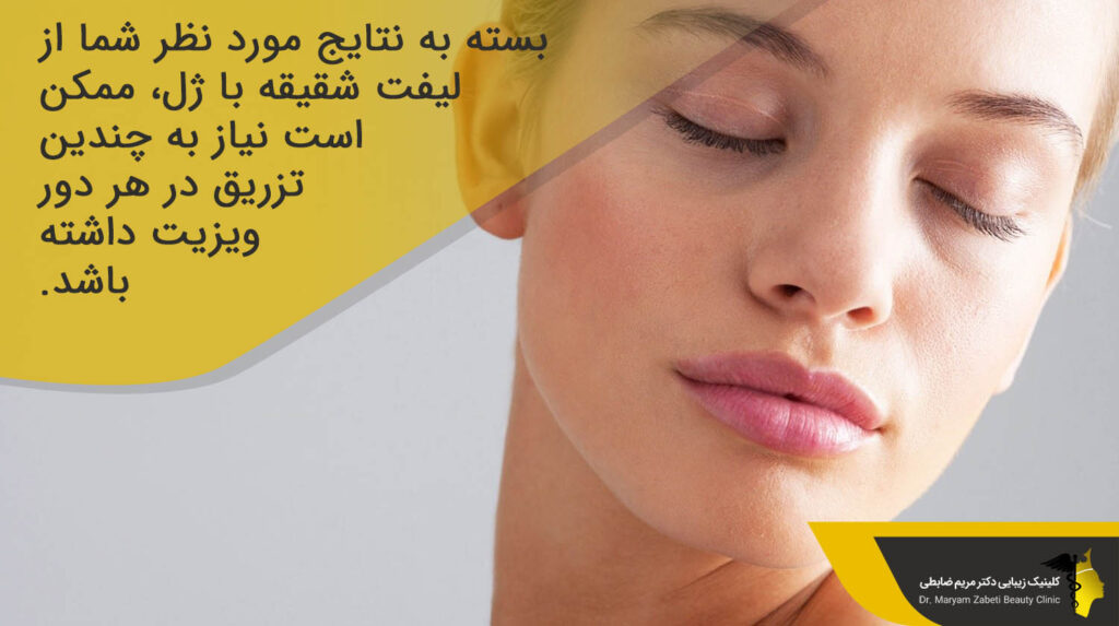 نتایج لیفت شقیقه با ژل