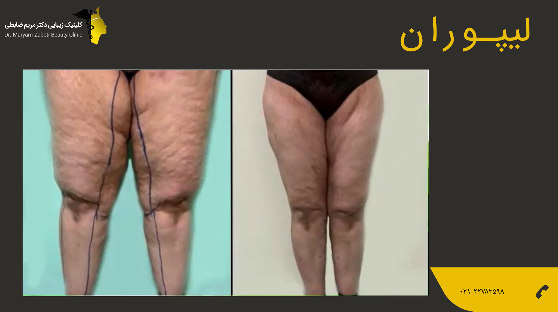 نمونه کار لیپو ران دکتر ضابطی