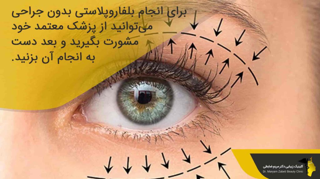 بلفاروپلاستی بدون جراحی چگونه انجام می ‌شود؟