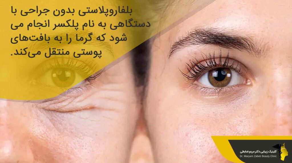 بلفاروپلاستی بدون جراحی چیست؟