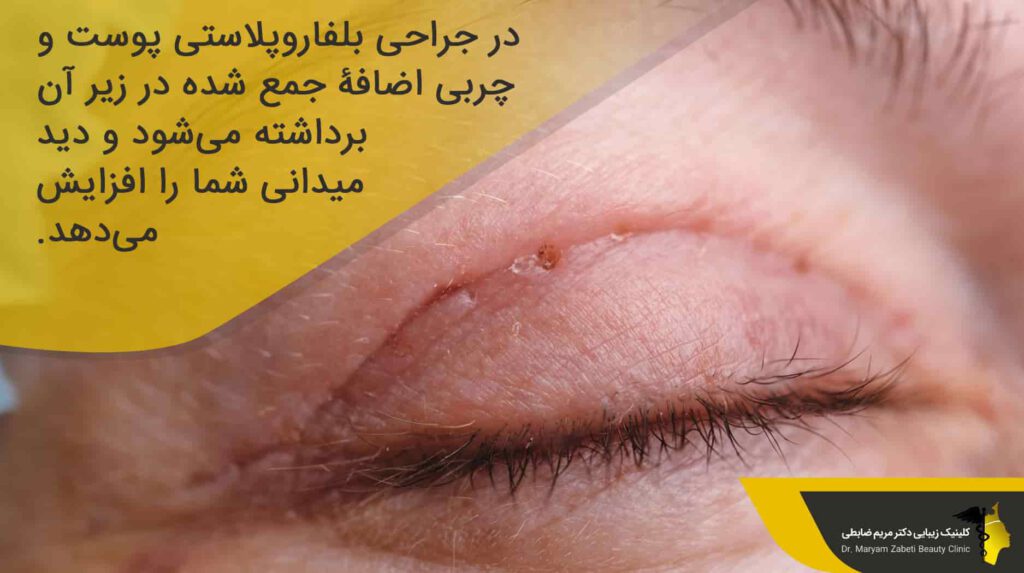 جراحی بلفاروپلاستی چیست