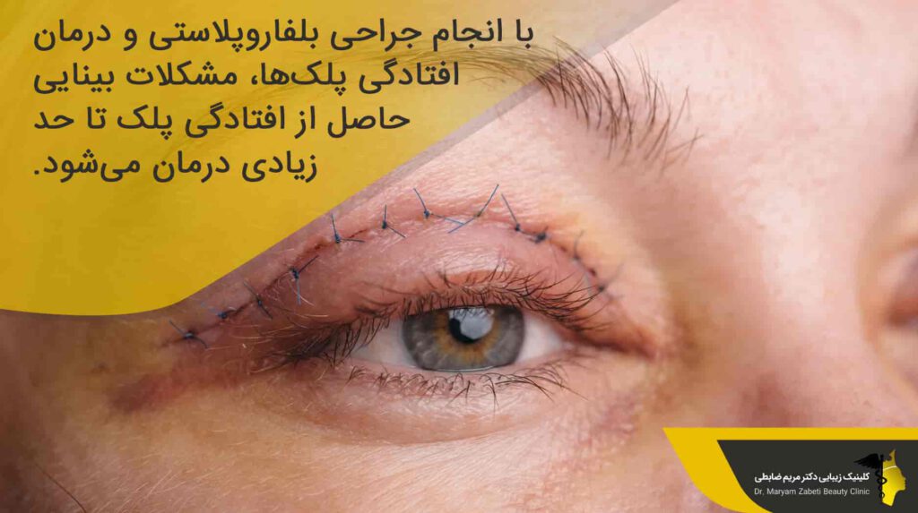 جراحی بلفاروپلاستی چیست و چرا انجام می‌ شود؟