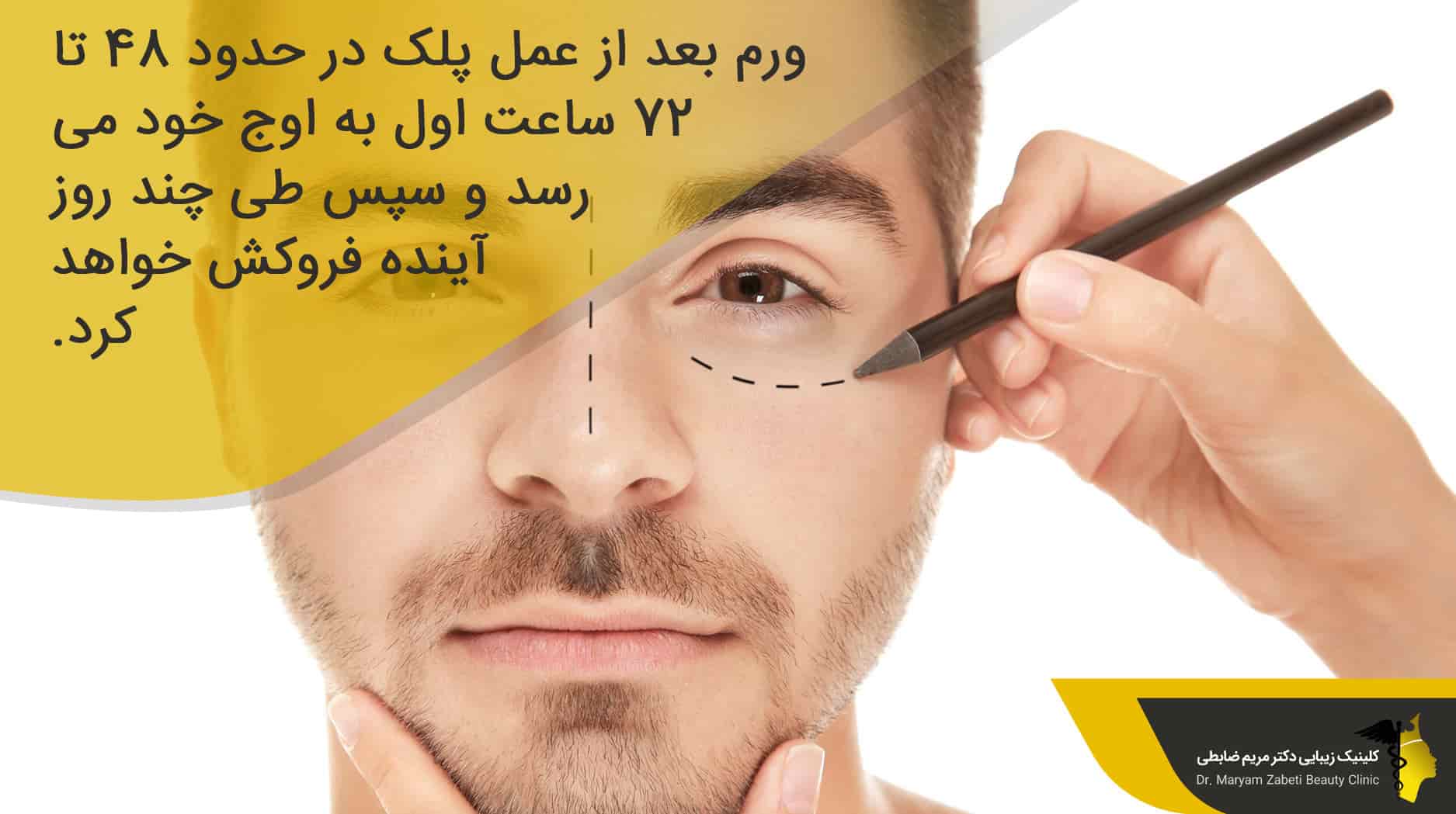علت ورم بعد از عمل بلفاروپلاستی