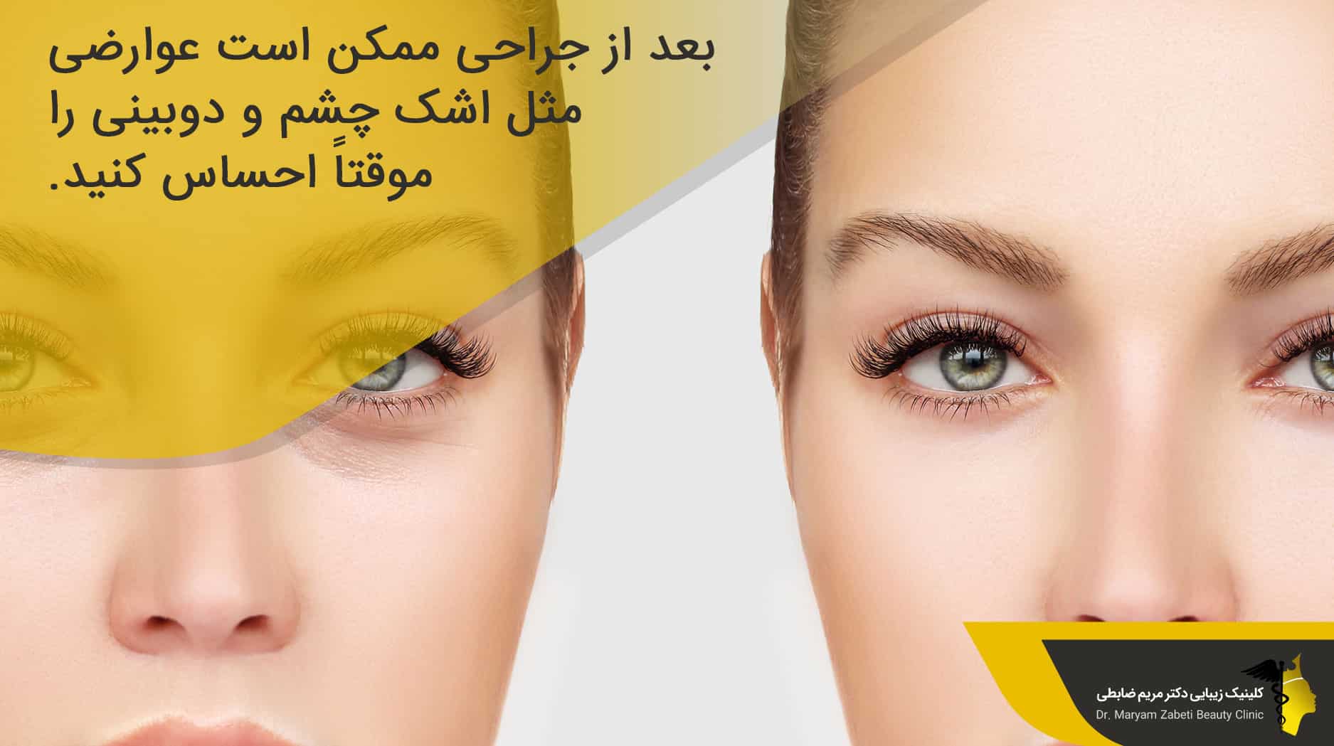 عوارض بعد از جراحی بلفاروپلاستی