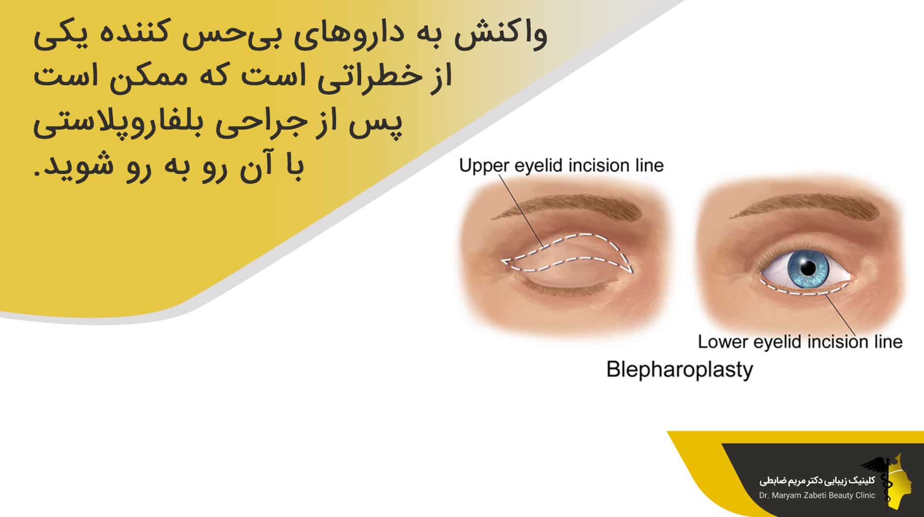 عوارض جراحی بلفاروپلاستی
