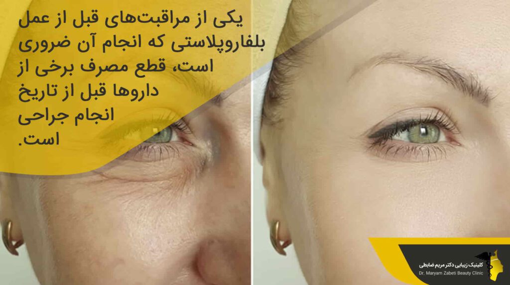 مراقبت‌های قبل از عمل بلفاروپلاستی‌