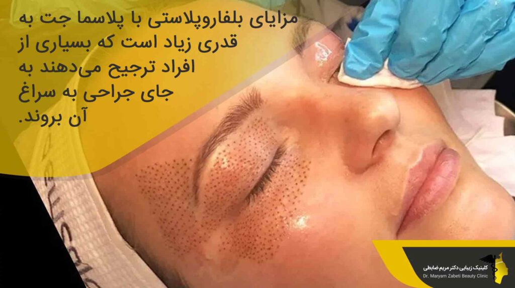 مزایای انجام بلفاروپلاستی با پلاسما جت