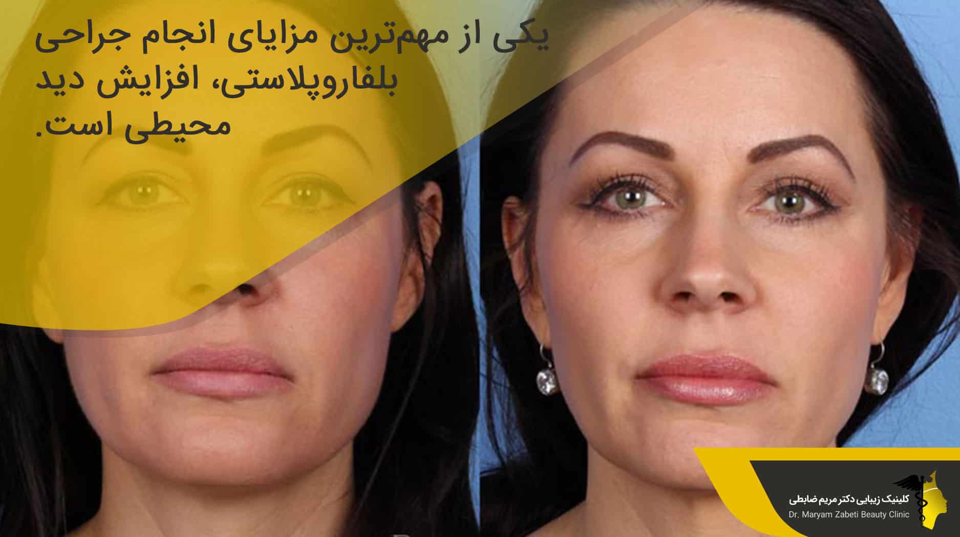مزایای انجام جراحی بلفاروپلاستی