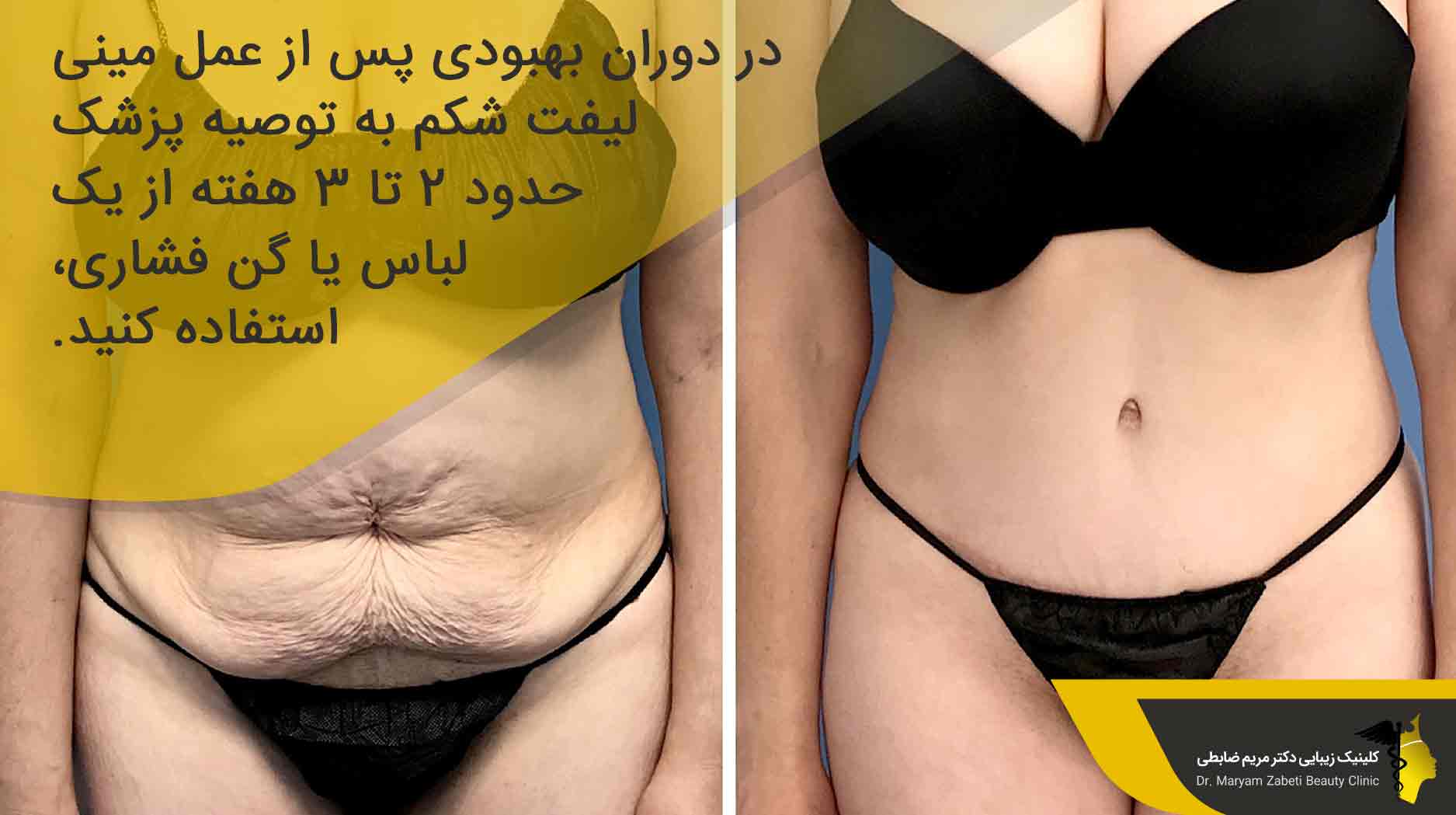 اقدامات بعد از جراحی مینی لیفت شکم 