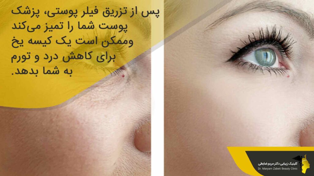تزریق فیلر چگونه انجام می‌شود؟