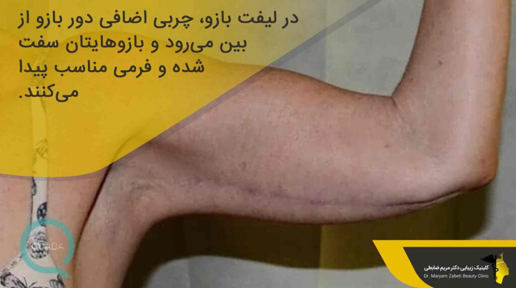 درمان افتادگی پوست بازو بدون نیاز به جراحی