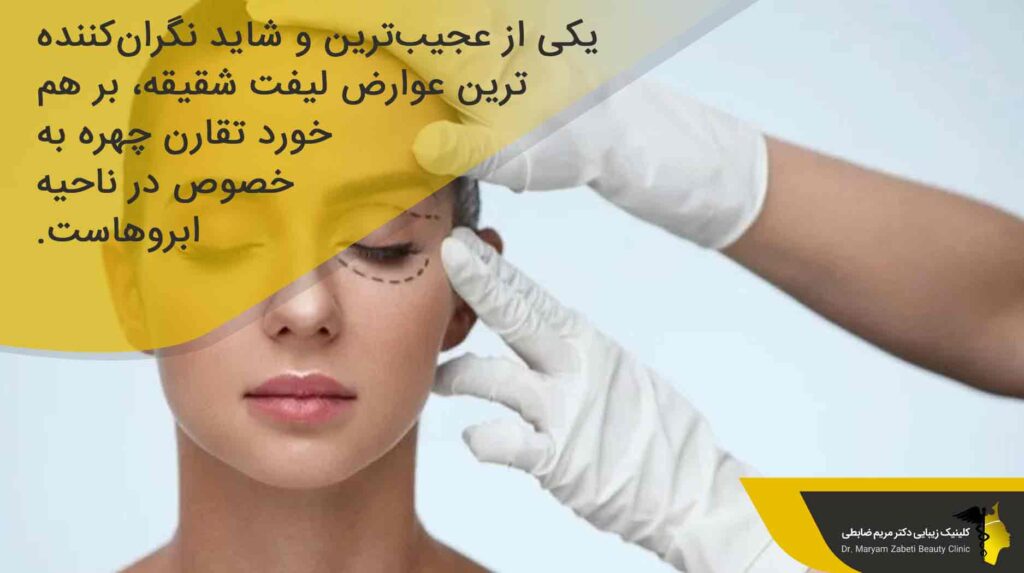 بر هم خوردن تقارن چهره بعد از جراحی لیفت شقیقه 