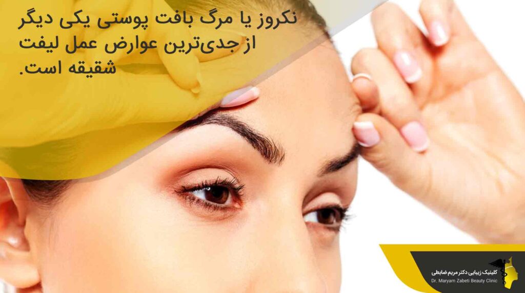 نکروز یا مرگ بافت پوست یکی از عوارض جراحی شقیقه 
