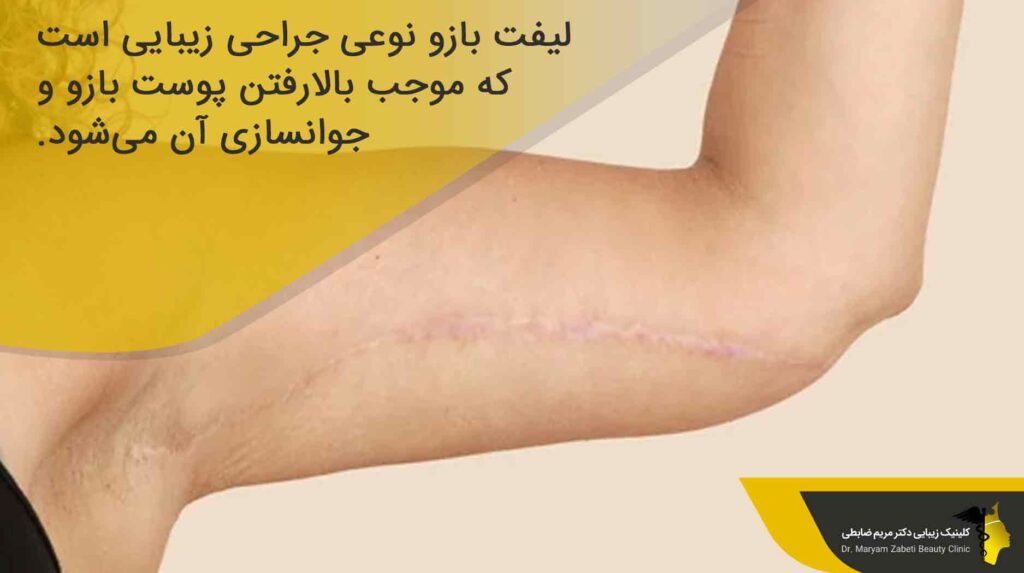  لیفت بازو چیست؟