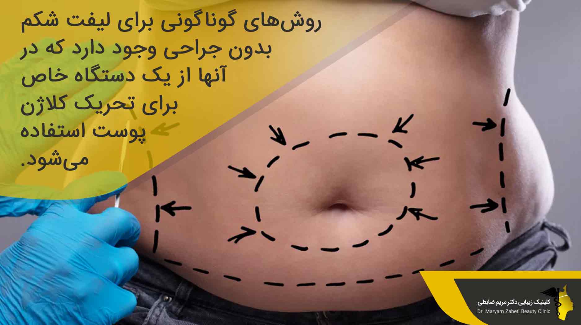  لیفت شکم بدون جراحی چگونه است؟ 