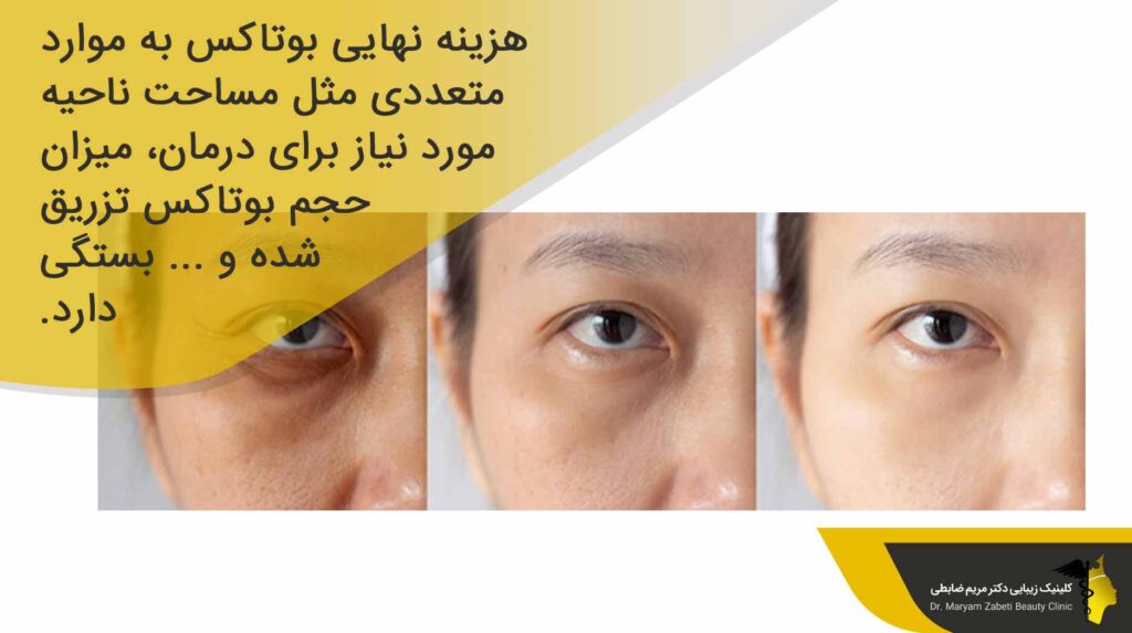 هزینه بوتاکس دور چشم چقدر است؟
