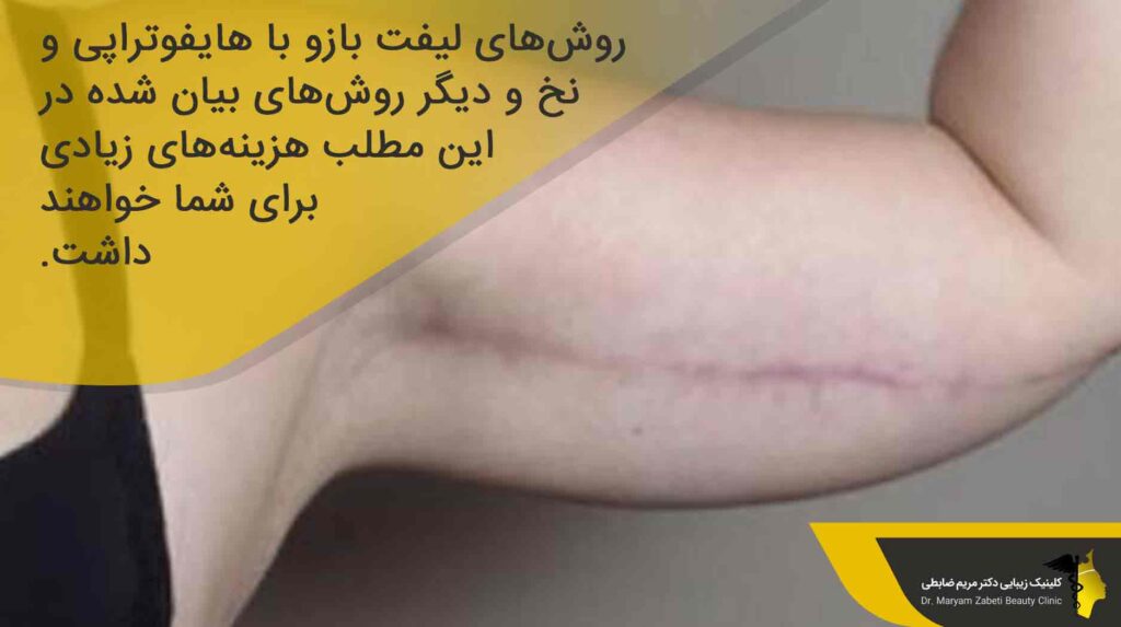 هزینه لیفت بازو بدون جراحی