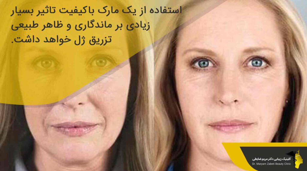 بهترین مارک ژل برای تزریق خط خنده